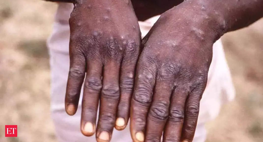 WHO to assess if monkeypox an int’l emergency